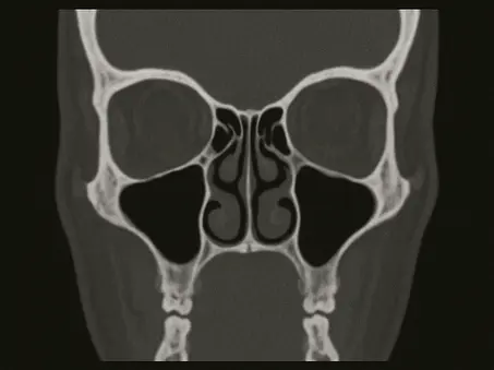 Scanner sinus (Cone Beam)